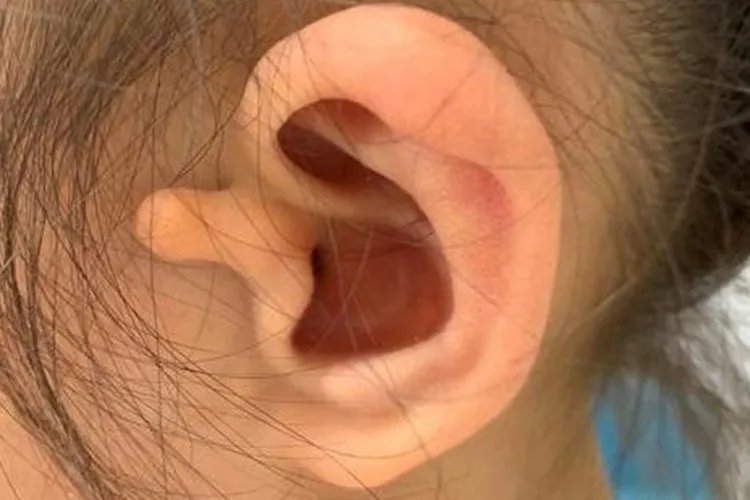 先天性耳朵畸形图片