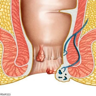 肛管癌的初期症状有哪些