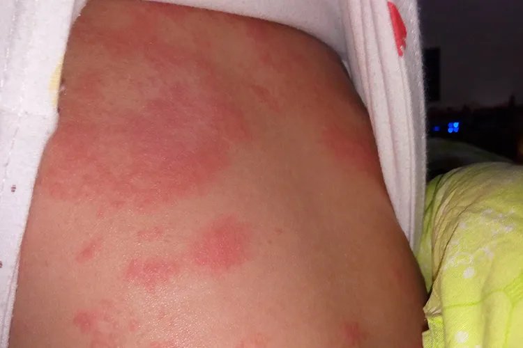 宝宝前胸后背红疹图片