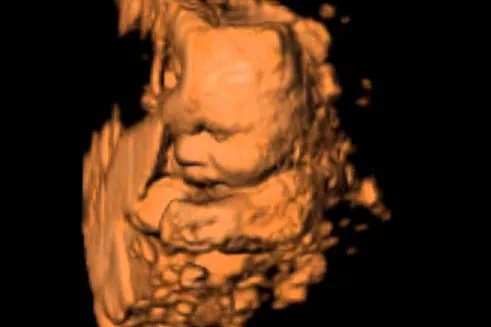 胎儿四维彩超图片