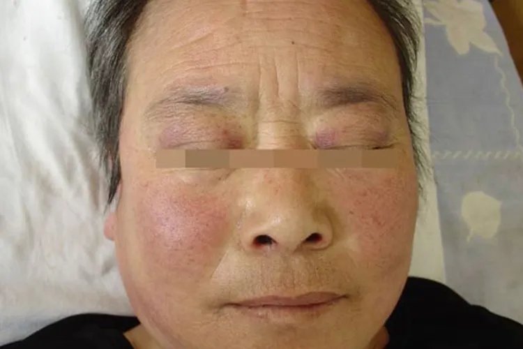 皮囊炎症状及图片