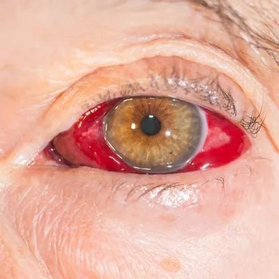 眼角膜出血该怎么办