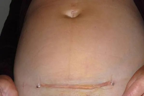 剖宫产正常疤痕图片