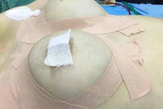 隆胸后的图片是怎样的