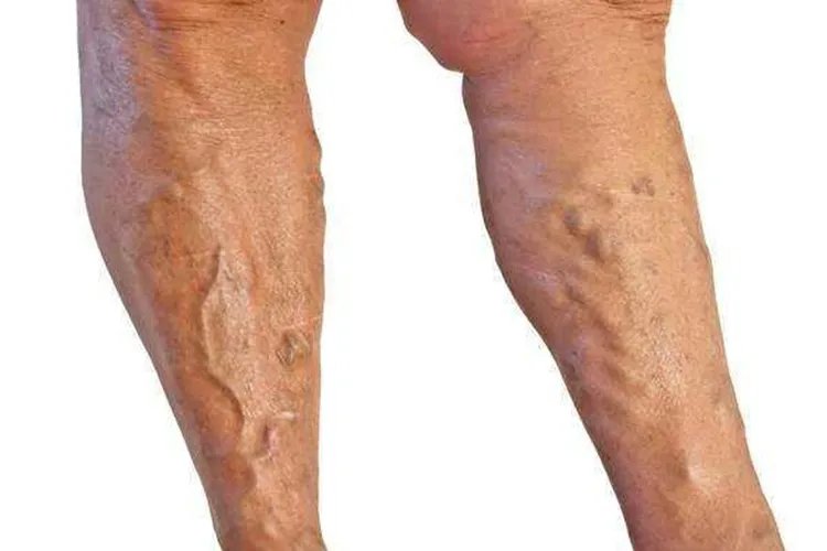 什么是静脉曲张图片