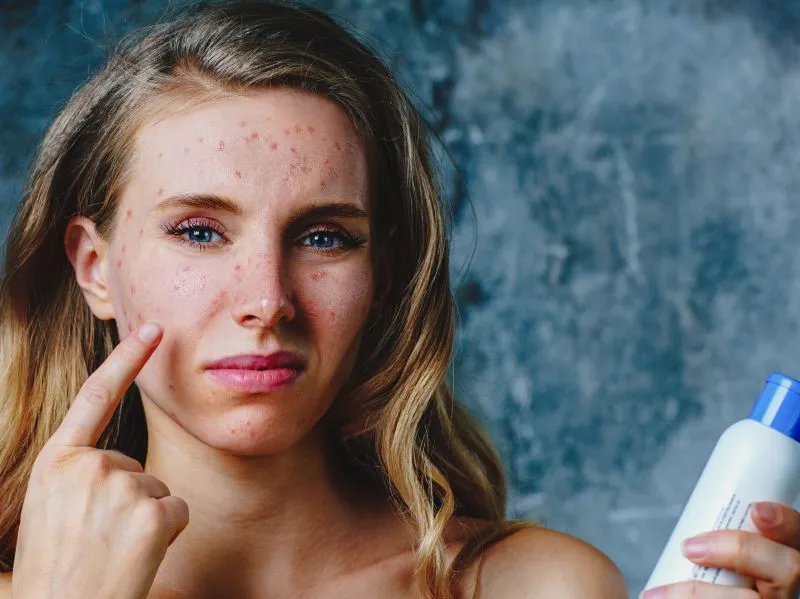 如何预防漆树过敏