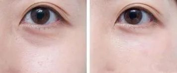 泪沟填充大概多少钱