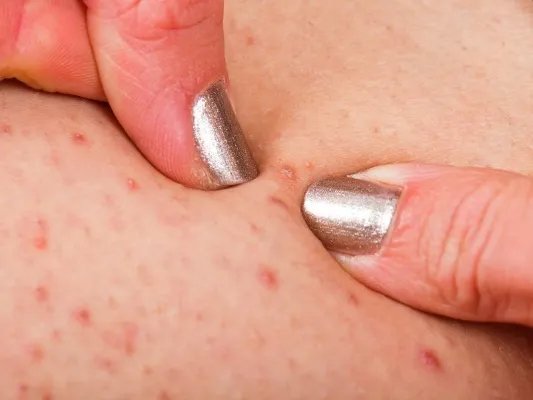 糠秕孢子菌毛囊炎是怎么回事