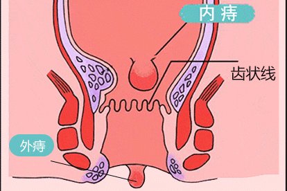 肛门外有个肉疙瘩图片