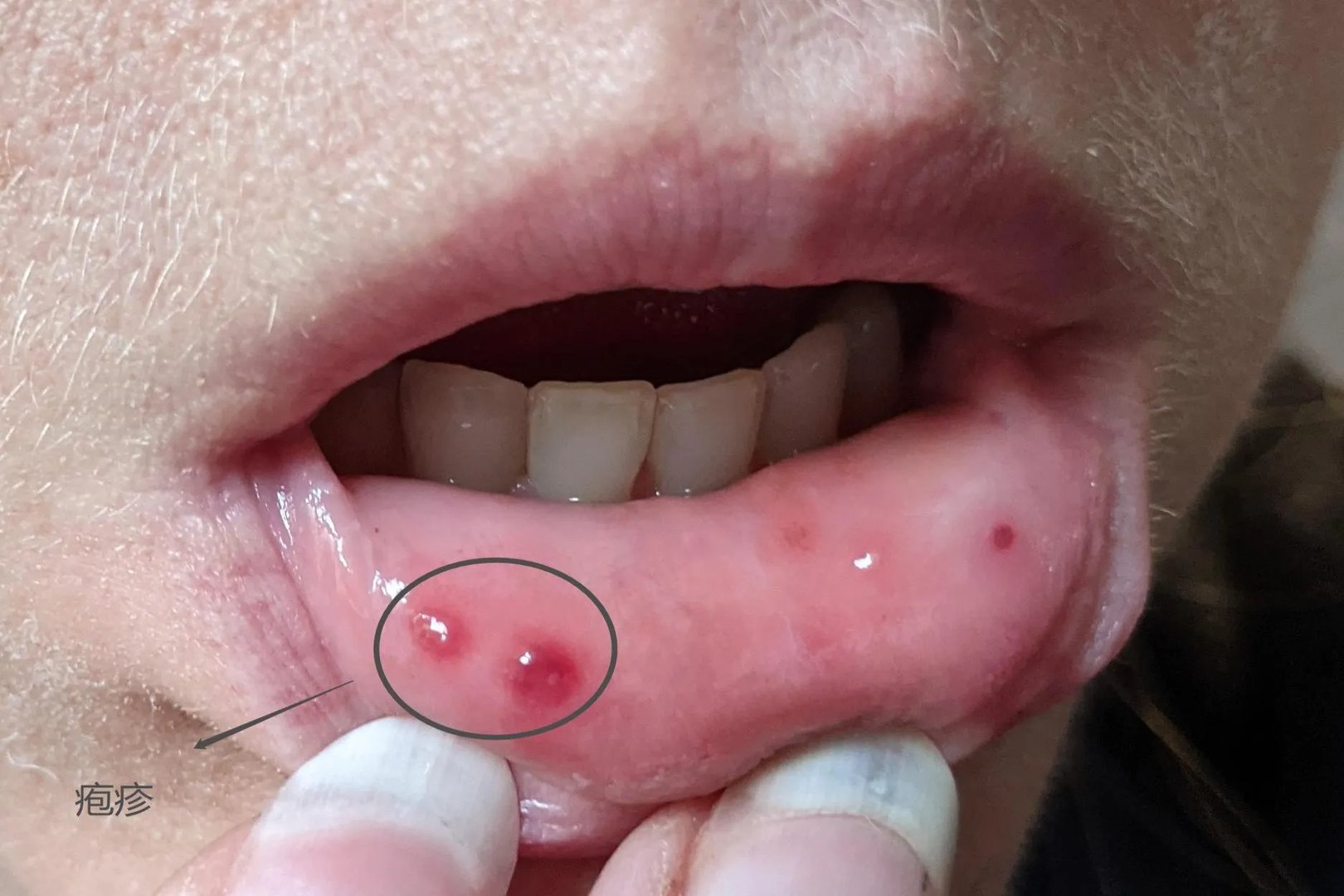 嘴唇里面长小疙瘩怎么回事图片