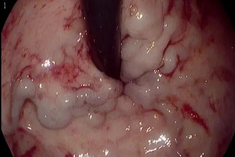 什么是静脉曲张图片