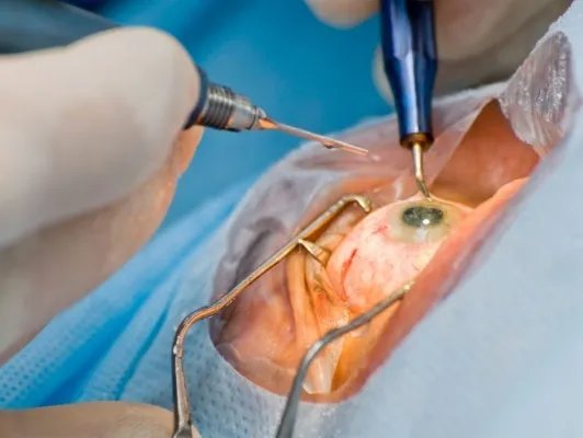 眼睛手术多少度不能做了