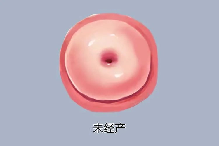 宫颈癌和正常宫颈图片