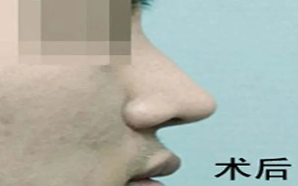 瑞蓝玻尿酸隆鼻多少钱