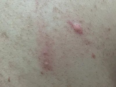 毛囊炎疙瘩图片