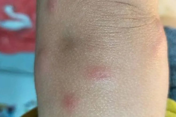 小儿荨麻疹图片初期症状图片