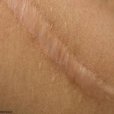 结节性血管炎是怎么回事