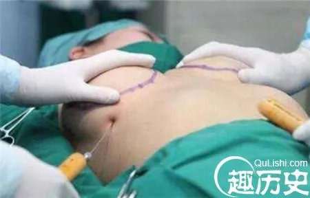 整容变毁容!女子隆胸像茄子严重变形超级难看