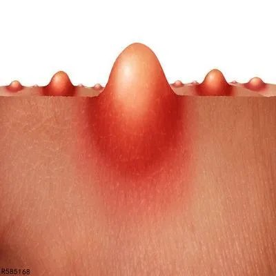 皮下脓肿是怎么形成的