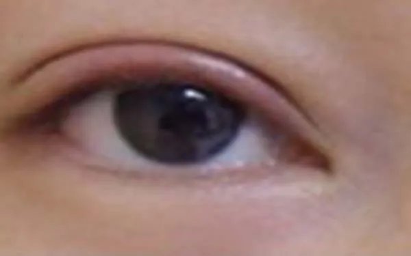 北京做双眼皮好的医院在哪里？