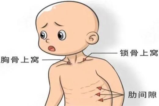 什么是三凹征图片