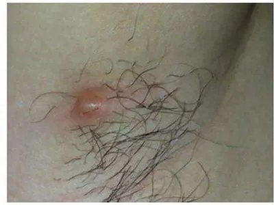 毛囊炎疙瘩图片