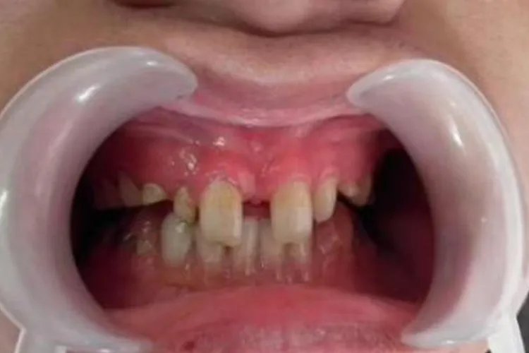 难看的牙齿图片大全