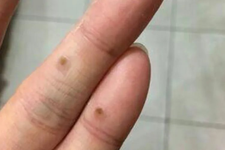 瘊子刚开始长的图片