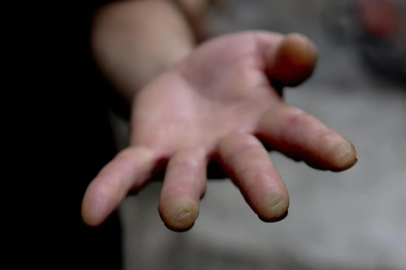 什么是胼胝图片大全