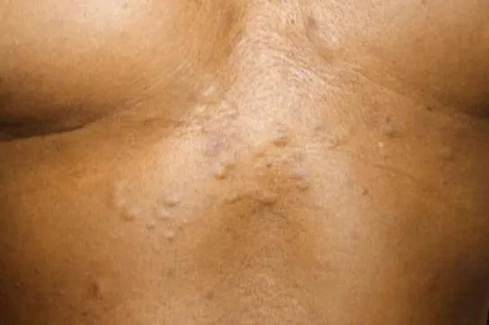 胸口长小肉粒图片