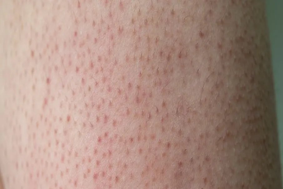 手臂鸡皮肤图片