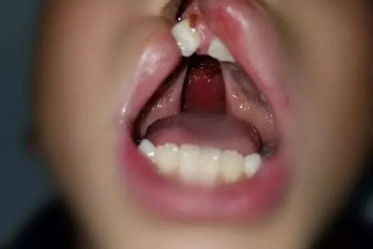 三度唇腭裂图片