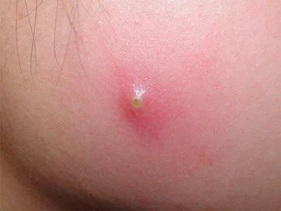 毛囊炎疙瘩图片