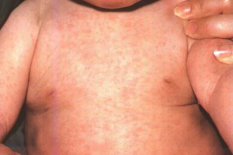 婴幼儿急疹图片