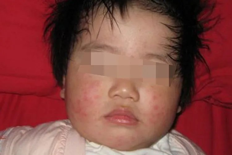 风疹症状图片及病因