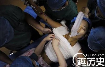 整容变毁容！女子隆胸像茄子严重变形超级难看