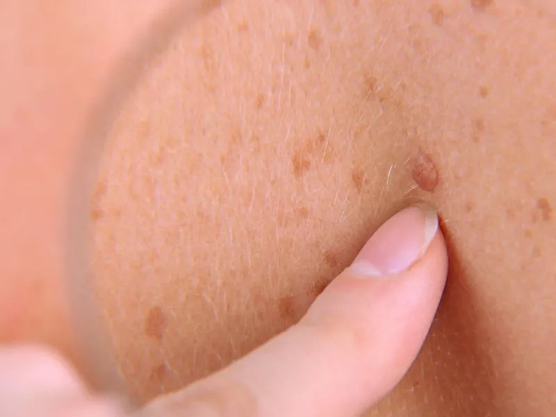 身上起小红点怎么办