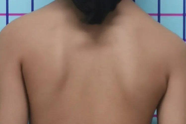 佝偻病儿童图片