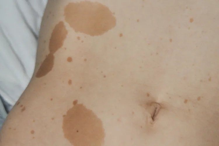 咖啡斑长什么样子图片