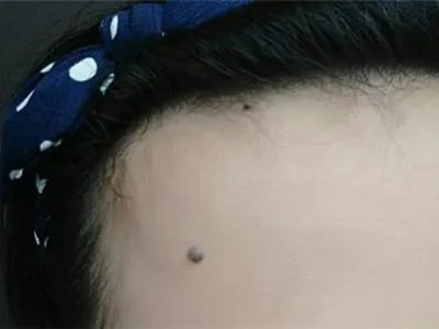 皮内痣黑痣图片