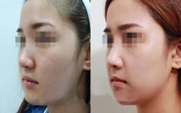 北京哪几家医院做膨体隆鼻好