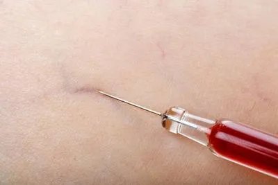 甲营养不良需要抽血化验吗