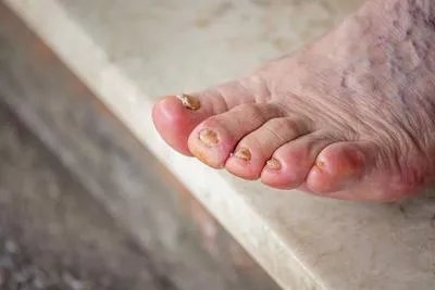 雷诺氏综合征怎么引起的