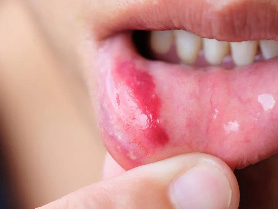 口腔溃疡怎么办? 口腔溃疡怎么治疗?