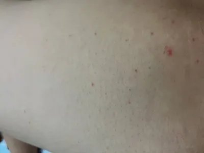 毛囊炎疙瘩图片