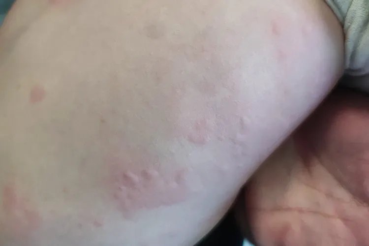 小儿荨麻疹图片初期症状图片