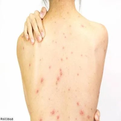 背部长痘是怎么回事