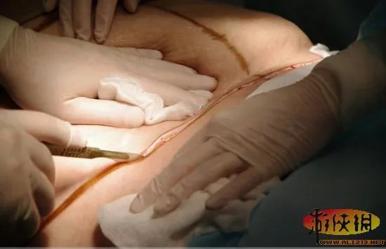 实拍恐怖整形吸脂手术全过程　胆小者慎入！