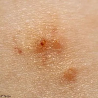 病毒疣应该用什么药比较好