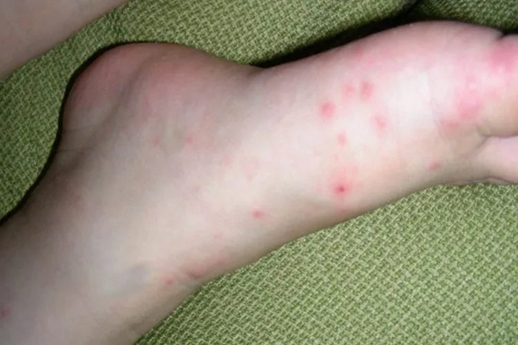 手足口病图片及治疗方法